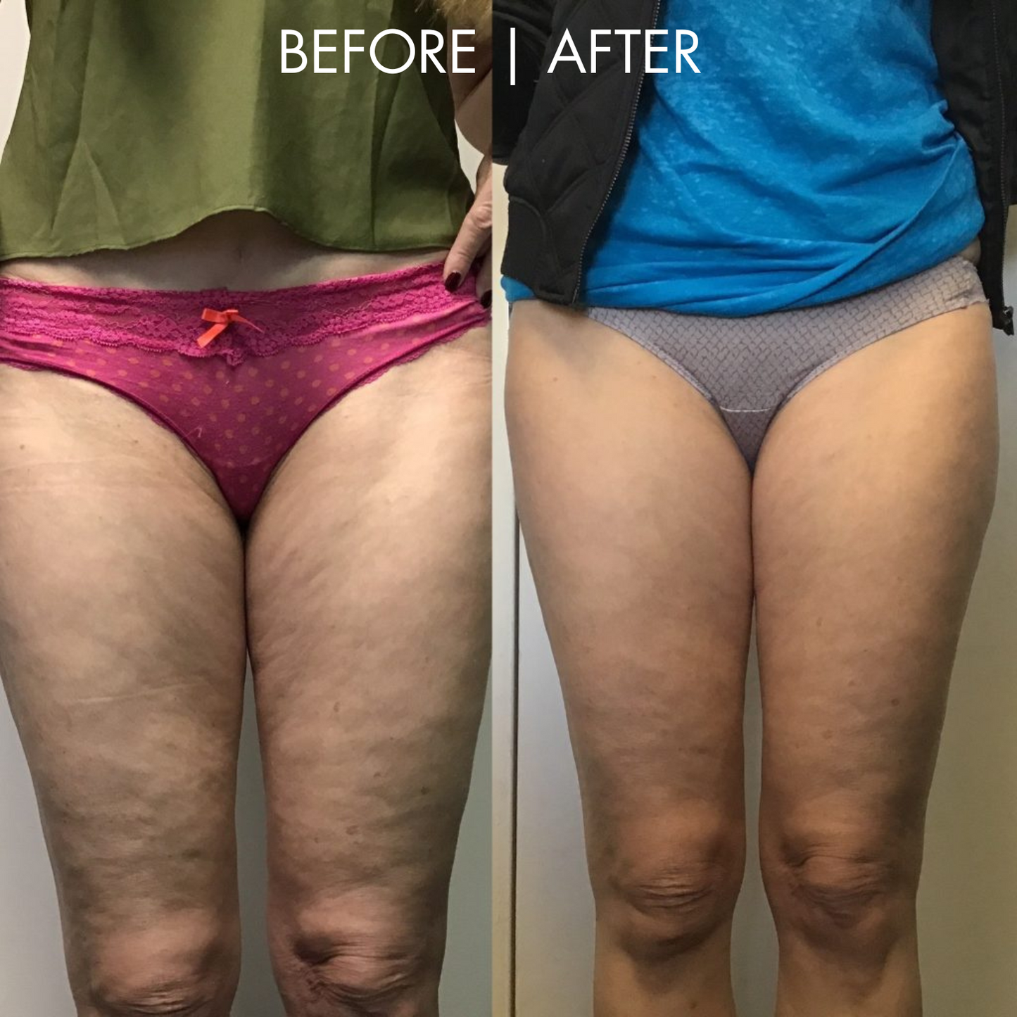 CelluGlow™ Cellulite Remover 2.0